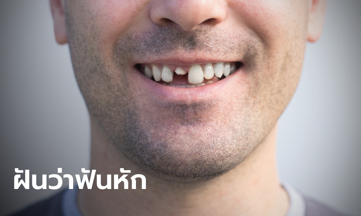 ฝันว่าฟันแตก ทำนายความฝัน