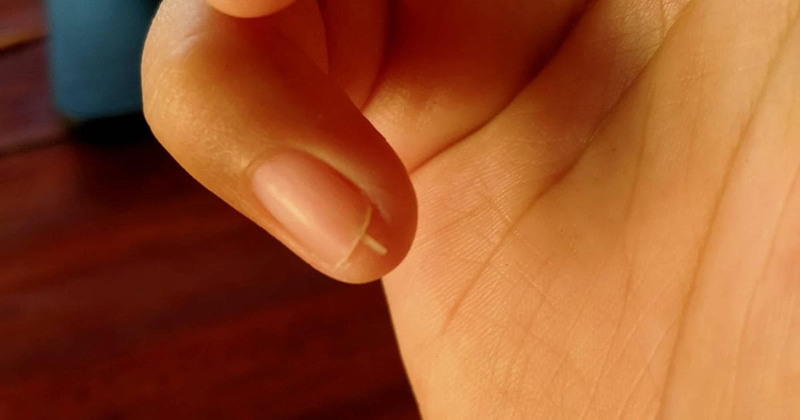 ฝันว่าเล็บหัก นิ้วก้อย ขวา - "Dreamed of a broken nail, right little finger"