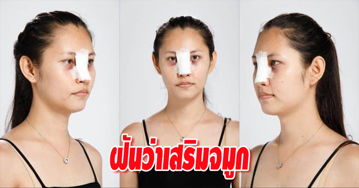 ฝันว่าเสริมจมูกแล้วทะลุ-"Dreaming about nose surgery"