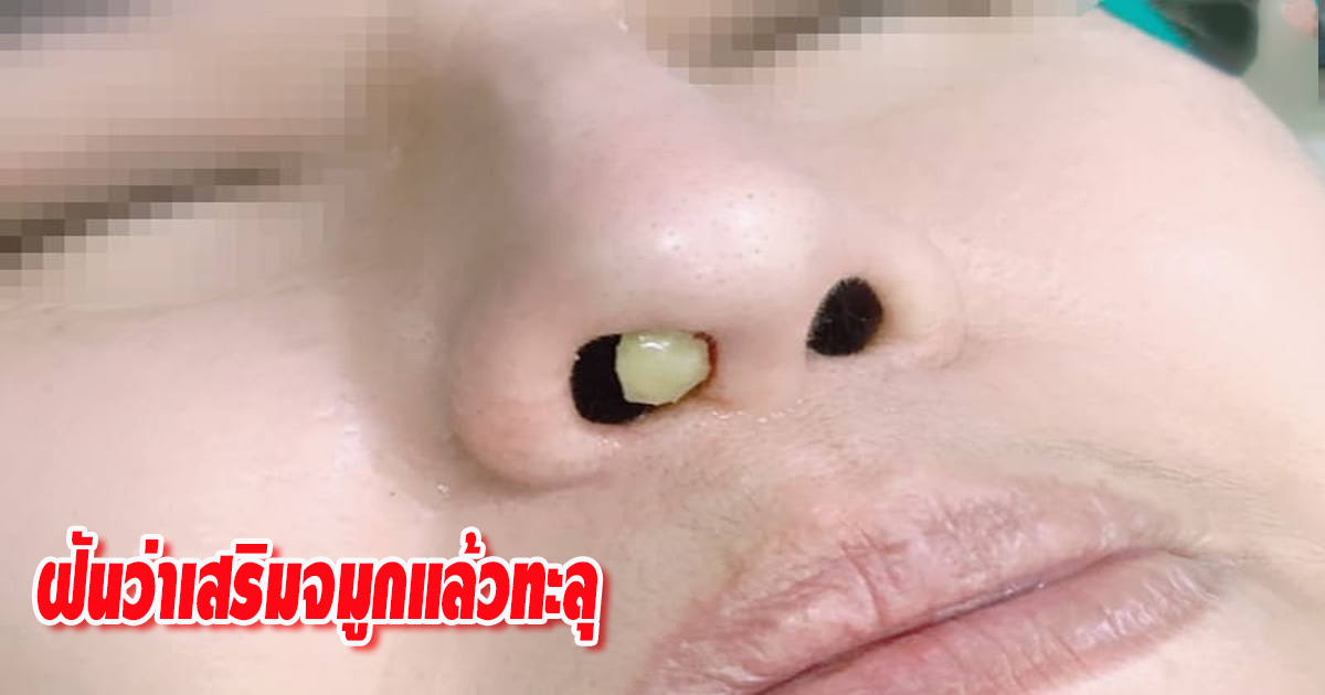 ฝันว่าเสริมจมูกแล้วทะลุ-"Nose augmentation and piercing"