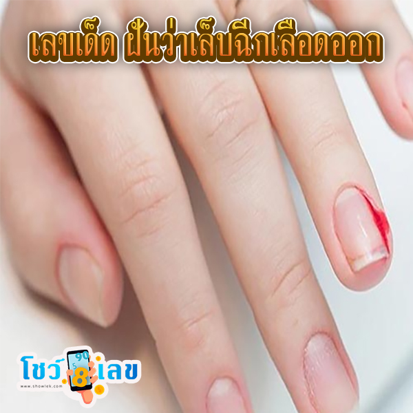 ฝันว่าเล็บฉีก เลขเด็ด -"Dreaming of a torn nail, lucky number"